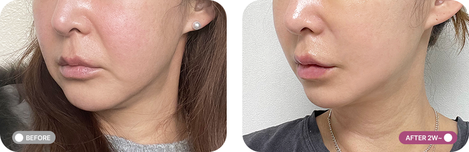 실리프팅 전후사진