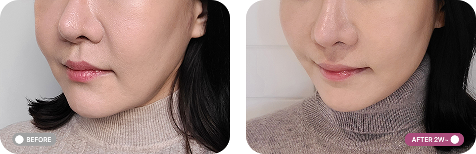 실리프팅 전후사진