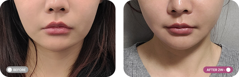 실리프팅 전후사진