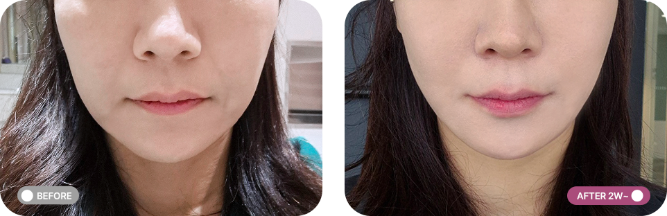 실리프팅 전후사진